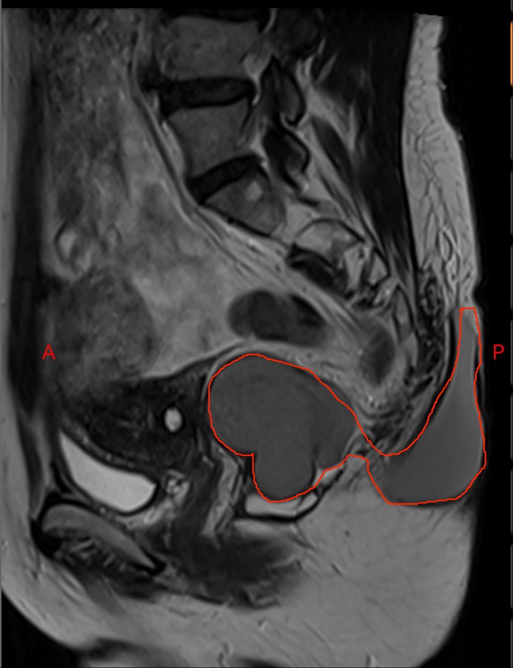臀部里长了个硬硬的瘤子,臀部上长个瘤子不疼不痒软软的