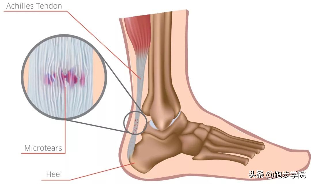 跟腱炎发病处理,跟腱炎如何治疗才能恢复