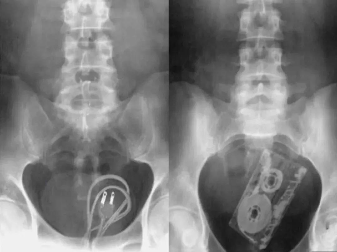 男子体内塞电线,男子嘴里塞了灯泡