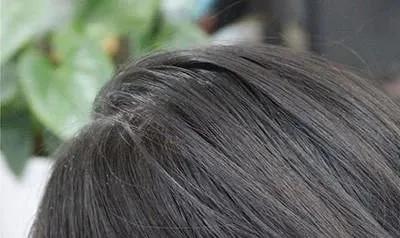 头皮屑是怎么形成的应该怎样去除,头皮屑多怎么去除头皮屑