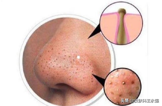 鼻子上挤出来黄色丝状物怎么解决,鼻子上挤出的白色状物到底是啥