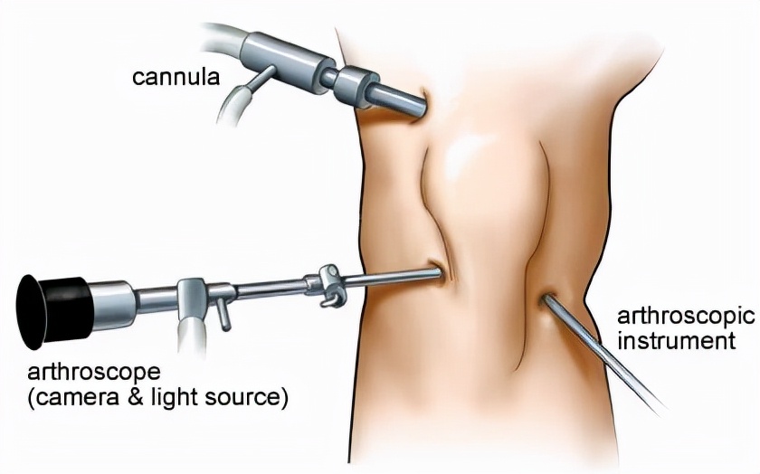 关节镜对膝骨性关节炎的效果如何,骨性关节炎做关节镜手术效果好吗