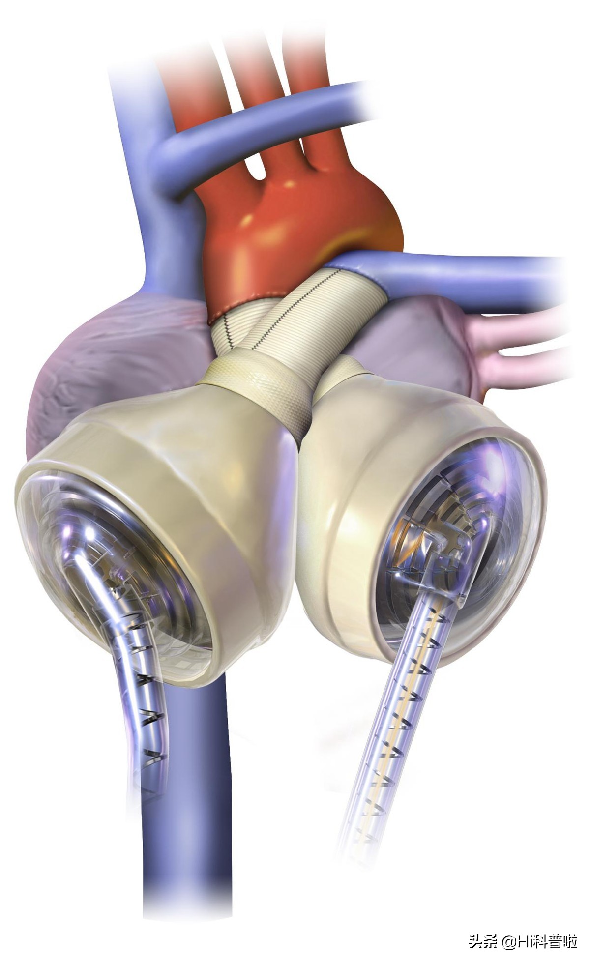 第四代磁悬浮人工心脏人民日报,中国成功研制出磁悬浮心脏了吗