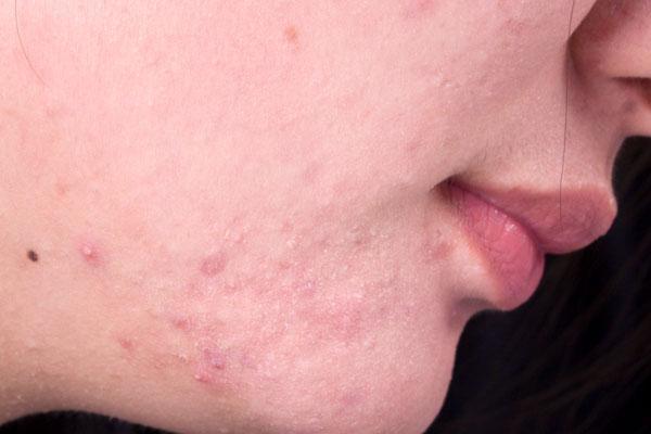 脸上的小肉粒怎么去除,为什么脸上会长小肉丁