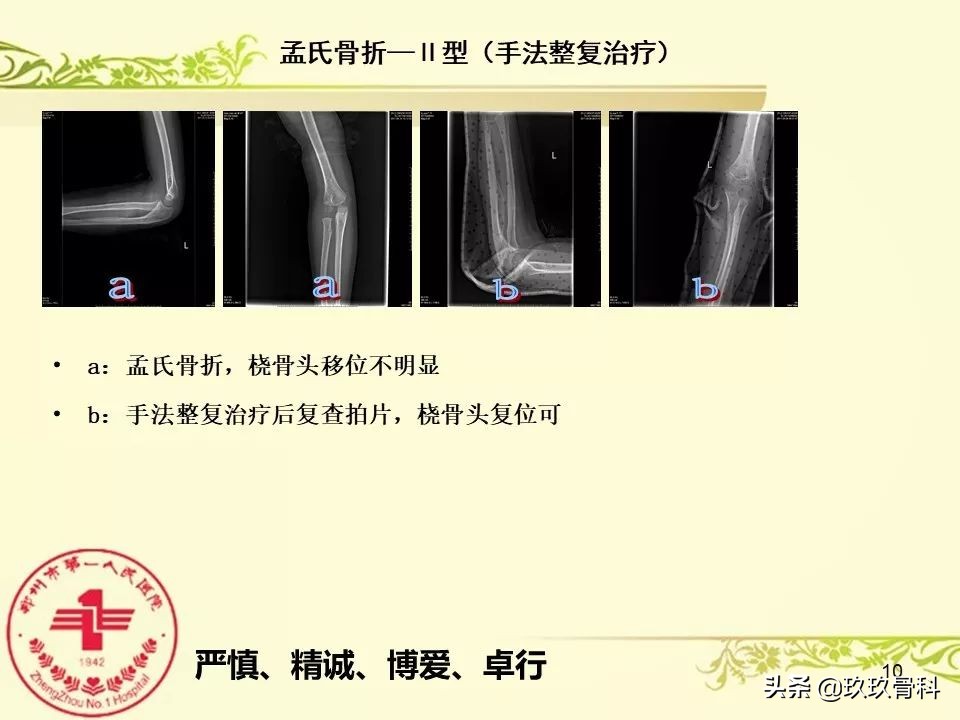 孟氏骨折功能训练多久能恢复正常,孟氏骨折中医能治吗