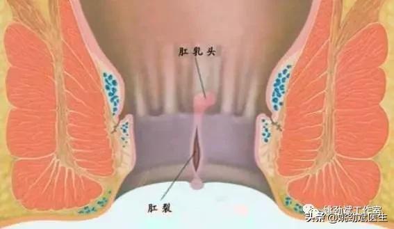 让人痛不欲生的“小病”——肛裂