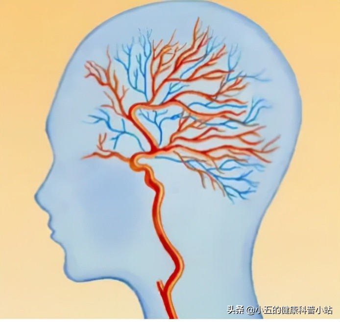华佗再造丸治好脑缺血灶吗,脑梗死吃华佗再造丸还是脑心通好