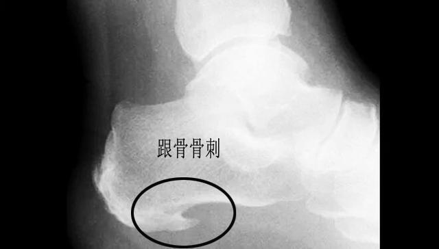 跑步足跟痛的原因及治疗方法,产后足跟痛是什么原因引起的