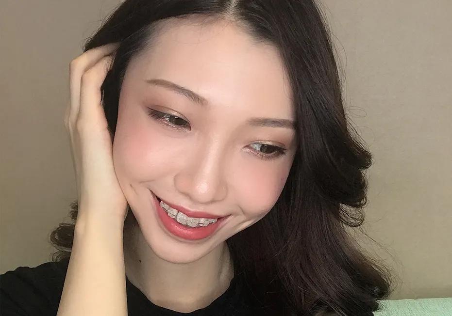 矫正牙齿的步骤及流程,矫正牙齿最快全过程