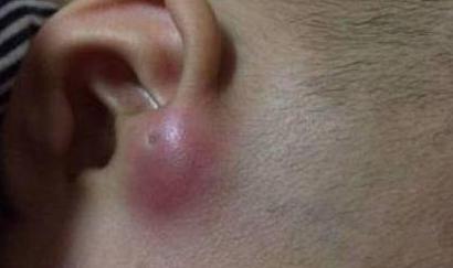 婴儿耳朵有个肉球什么时候能去掉,宝宝耳朵长小肉球要几岁动手术