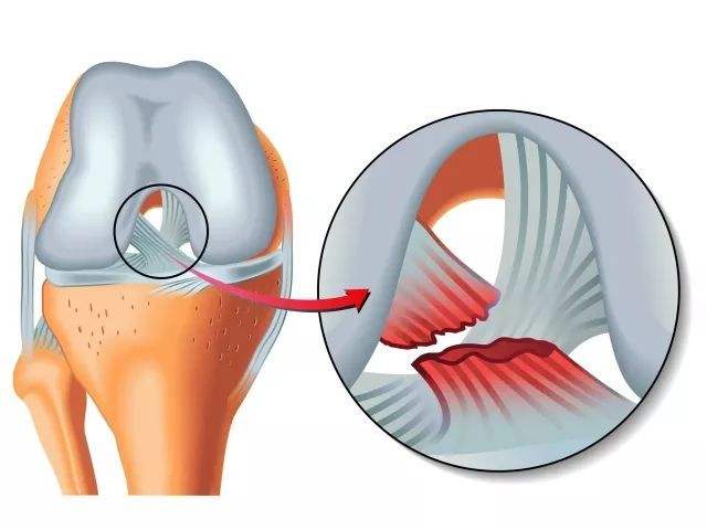 前交叉韧带断裂重建术后怎样恢复,前交叉韧带断裂手术全流程真实