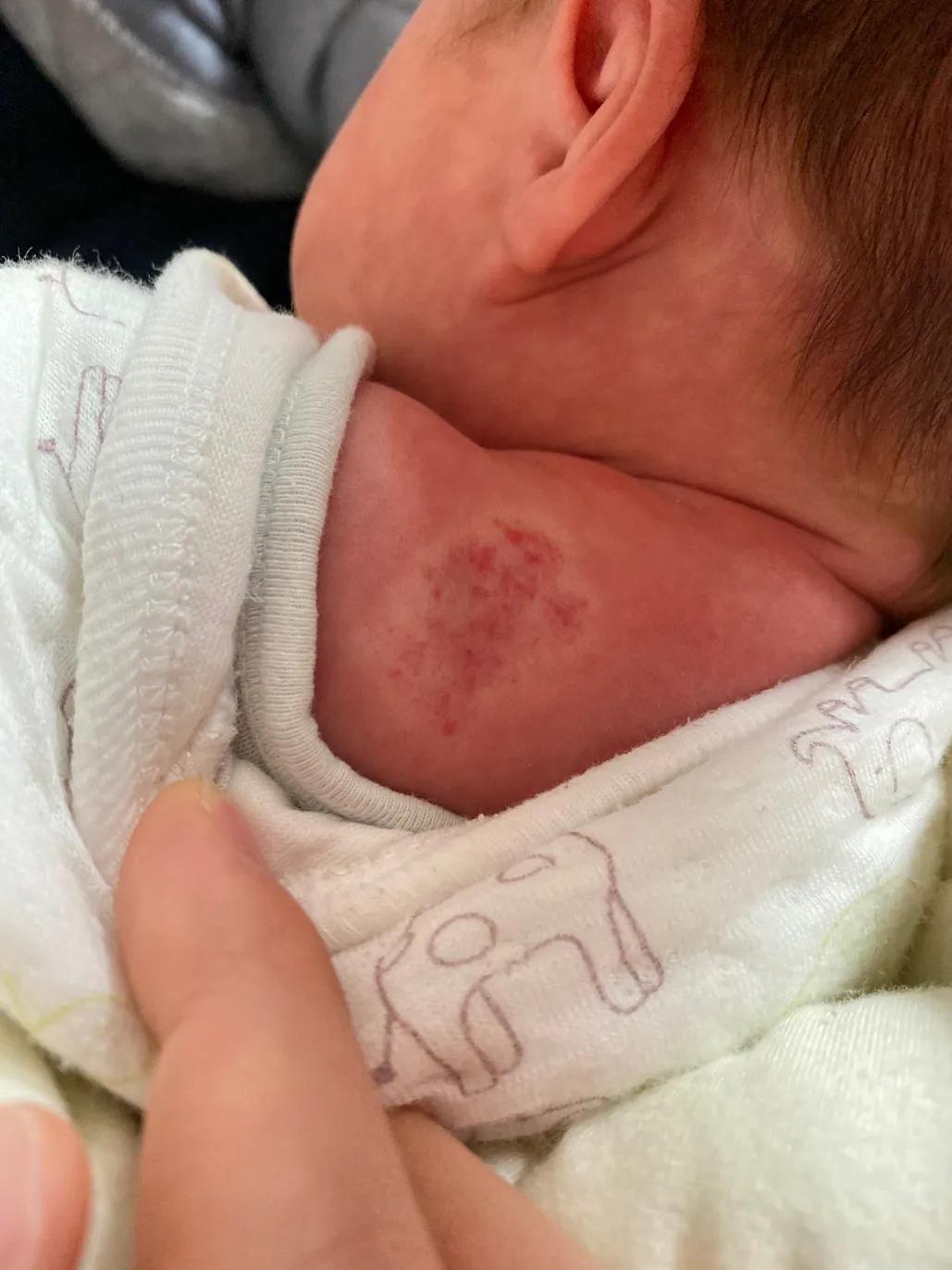 宝宝血管瘤用眼药水以后1个月淡化好多（带图）