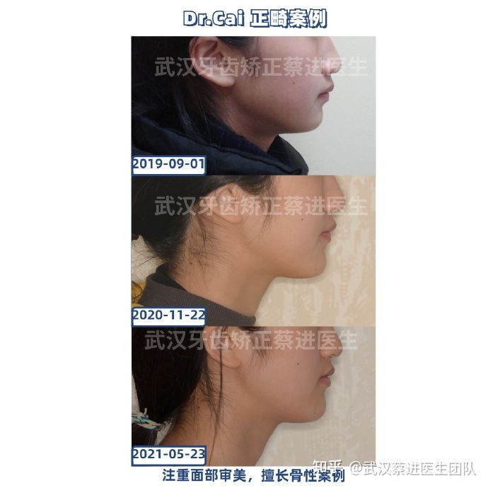 武汉牙齿反颌矫正最佳方案,牙齿矫正可以改善口呼吸面容吗