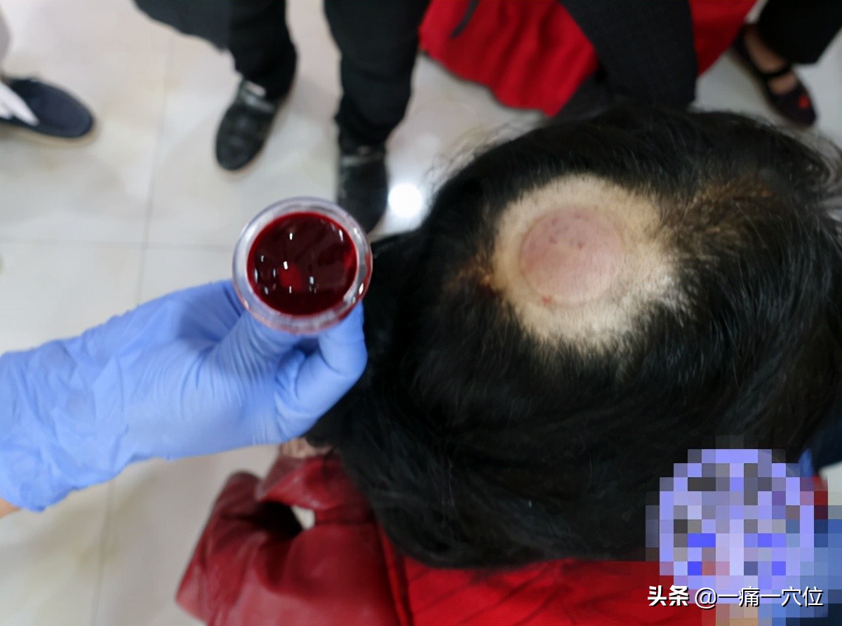 头顶疼痛怎么治疗最快最有效,头顶痛的最佳解决办法