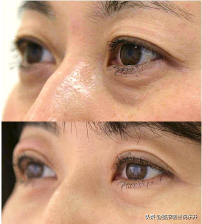 祛眼袋后眼袋出现皱纹怎么办,祛眼袋后凹陷怎么办
