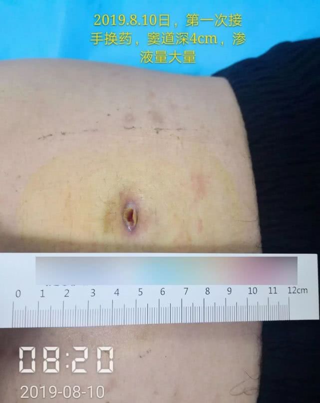 阑尾炎形成窦道的原因,阑尾炎一孔微创手术全过程