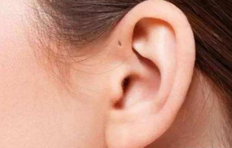 为什么婴儿耳朵后边都有一个疙瘩,耳朵有个小孔是怎么回事流水很臭