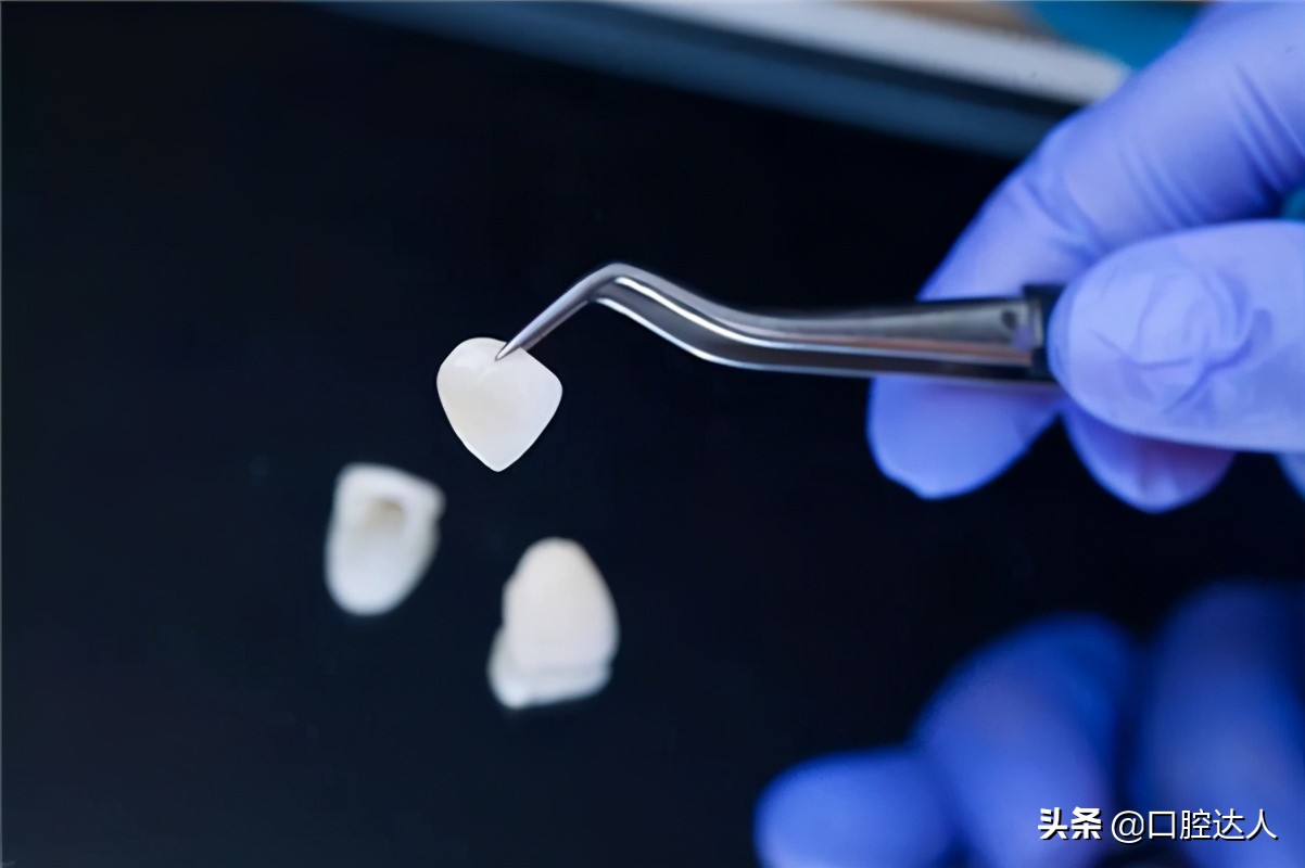 贴面矫正牙缝,全瓷贴面补牙缝多少钱