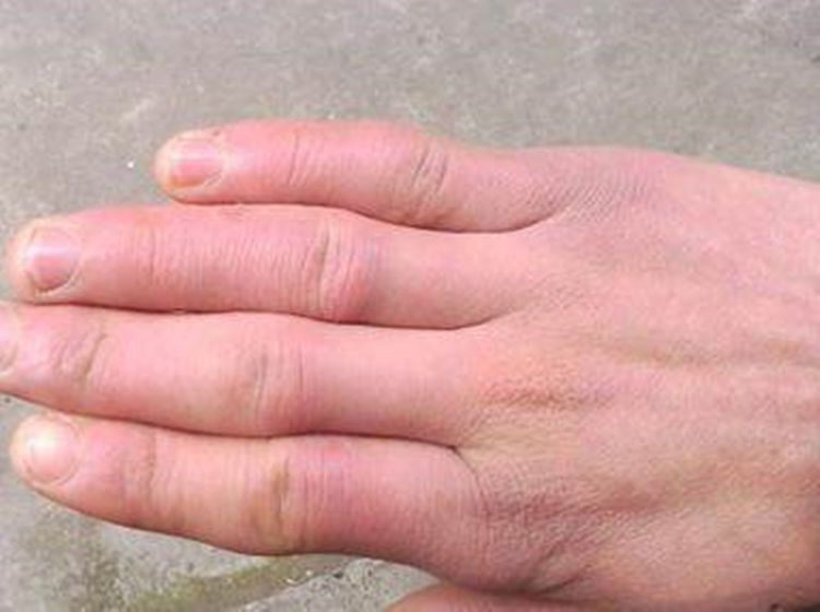 最快解决口腔溃疡的小妙招,口腔内侧有黑头怎么办