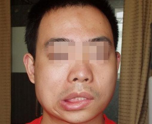 面神经炎治疗首选什么药,面神经炎的康复训练视频