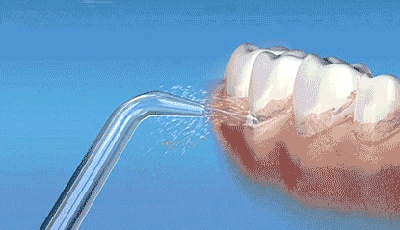 青少年整牙会出现黑三角吗,上牙有黑三角吗