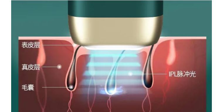 j-style脱毛仪怎么用,j-style脱毛仪怎样