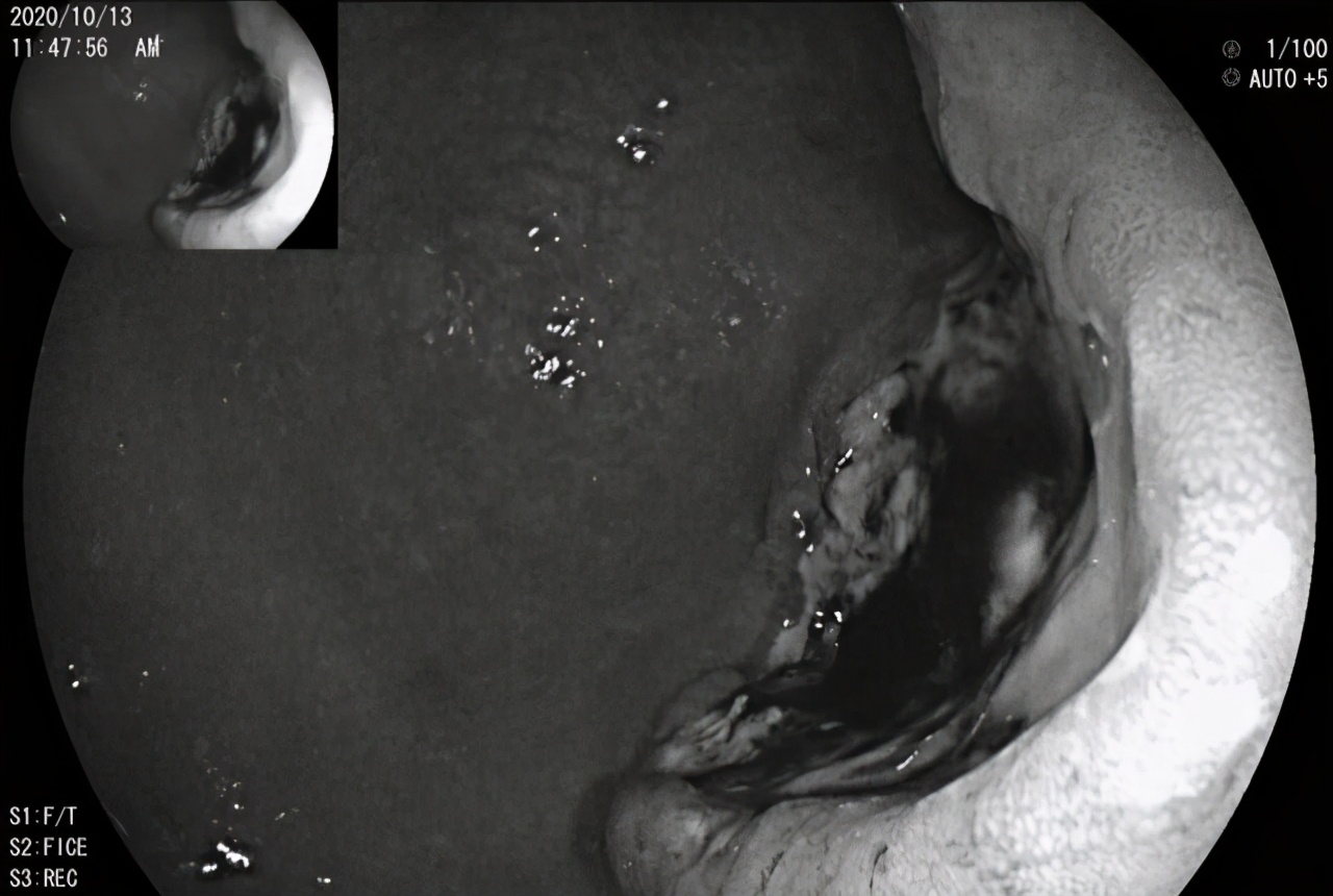 35岁胃癌晚期,胃癌的高危人群几年做一回胃镜