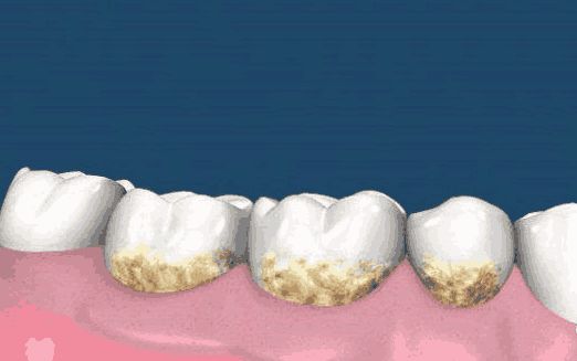 如何日常护理牙齿,平时怎样做好牙齿的保护
