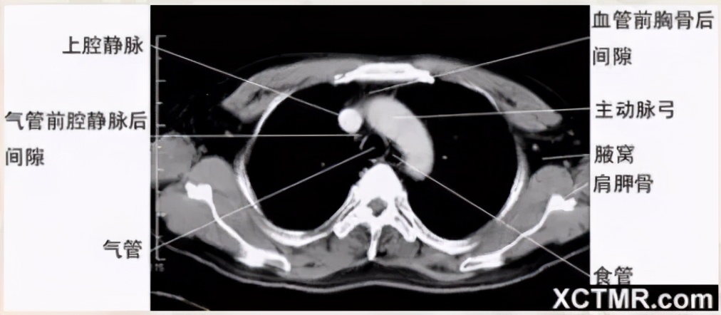 女性盆腔ct断层解剖结构图,女性盆腔脏器ct解剖