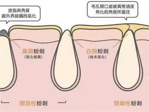 闭口痘痘就要一直涂闭口的药吗,脸上长闭口真闭口和假闭口