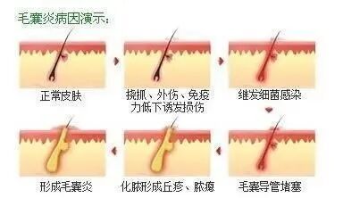 毛囊炎是一个圆形的红疙瘩,毛囊炎起一个很痒的痘
