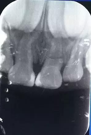 把握黄金45小时减少脑梗后遗症,把握好5个黄金时刻改变孩子一生