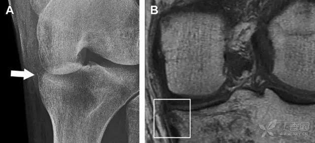 特殊骨折类型,特殊骨折体征