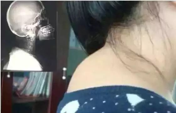 老中医跳起来治疗富贵包,老中医治富贵包的视频