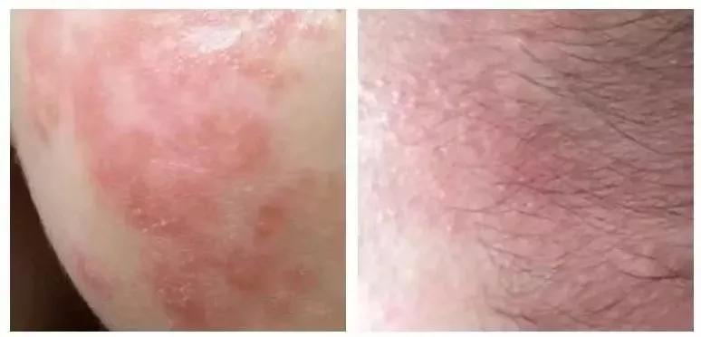 皲裂红脸蛋,宝宝皮肤皲裂擦面霜泛红