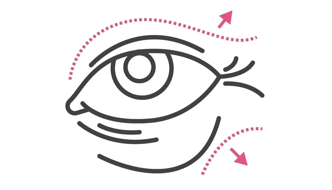 有效去除眼纹眼霜,眼纹可以通过医美什么方式治疗