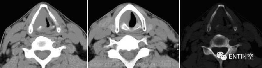 主任读片会：六大「喉部典型病例」大饱眼福