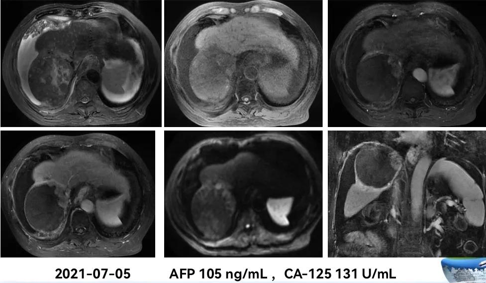 肝癌晚期靶向治疗怎么做,中国肝癌tace治疗展望