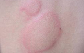 长期皮肤问题困扰的你,3种皮肤问题要重视