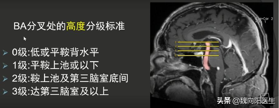耳眩晕是什么疾病,眩晕常见疾病之梅尼埃