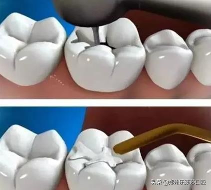 有一点点龋齿需要补牙吗,很严重的龋齿补牙需要什么流程