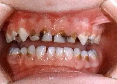 一个月宝宝口腔上颚白色的是什么,婴儿口腔上颚有一个小米样的白点