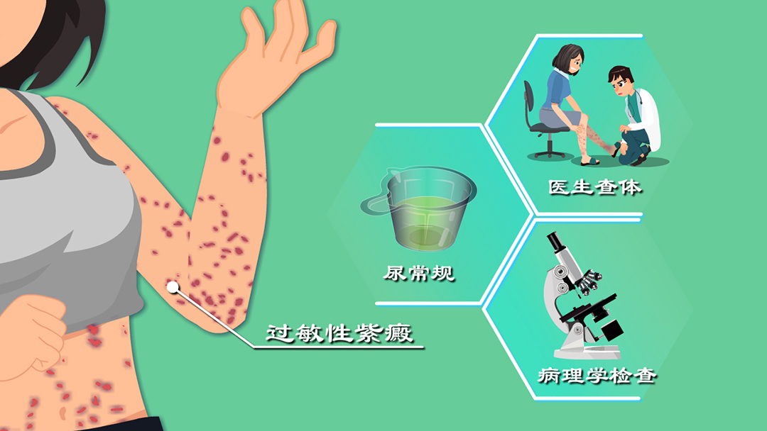 蚊虫叮咬导致过敏性紫癜,过敏性紫癜被蚊虫咬