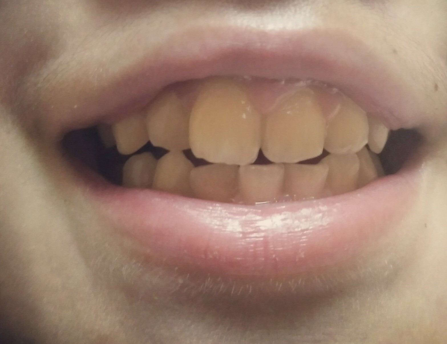 孩子换牙时期,没有做好这几件事,可能要花很长时间去弥补