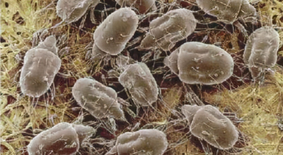 螨虫造成的头皮屑怎么治,头皮屑里有没有螨虫