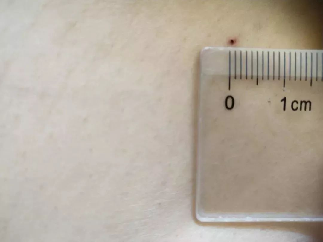 子宫肌瘤无创消融手术,无疤痕子宫肌瘤手术