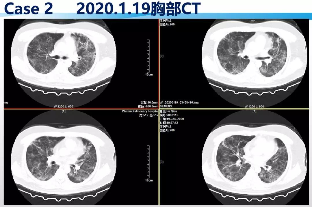 赵建平:重症CAP存在过度炎症反应时合理应用激素可减轻