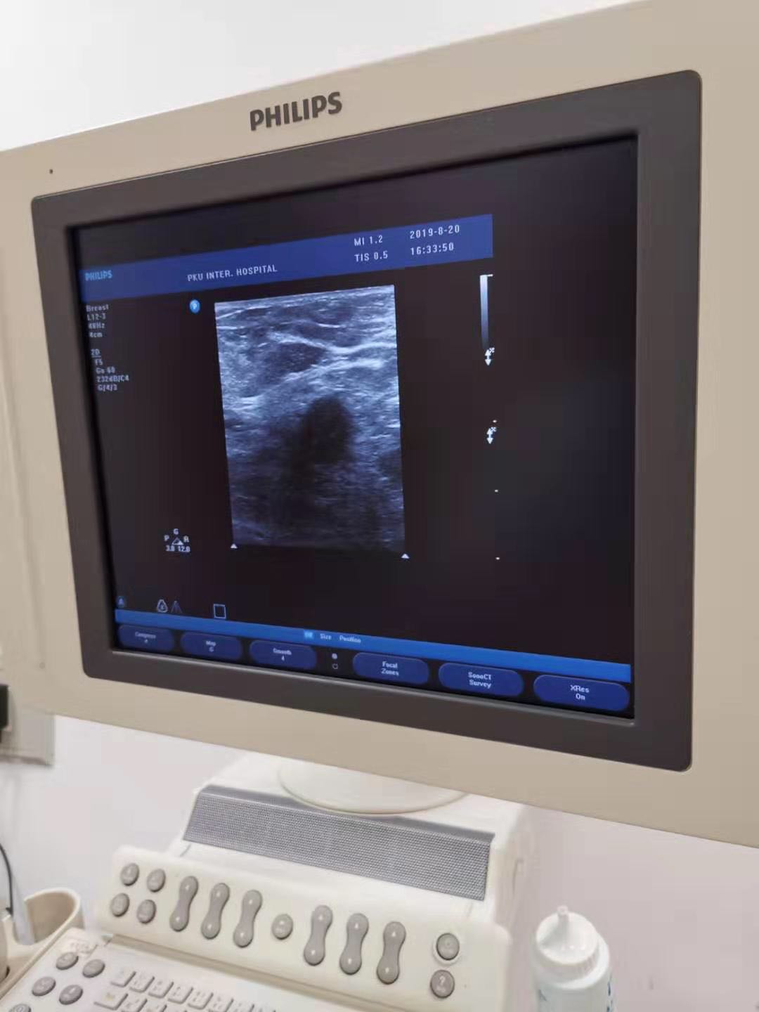 “小护”详解乳腺穿刺活检术，让您不再恐惧这项重要检查