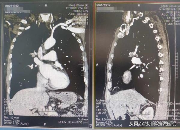 拯救老烟枪！苏州科技城医院单孔下成功切除中央型肿瘤