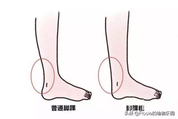 脚踝受限跛脚如何纠正,脚受伤后怎么锻炼脚踝的灵活性